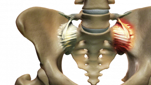 Excessive motion in the SI joint may inflame and disrupt the joint and surrounding nerves causing pain in the lower back, hip, groin, or pelvis.